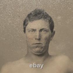 Believed To Be Wounded CIVIL War Soldier Tintype Photograph Face Shirtless Union